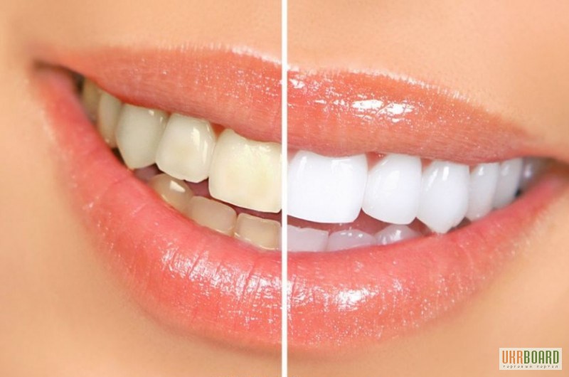 Фото 2. Система відбілювання зубів Dent 3D White