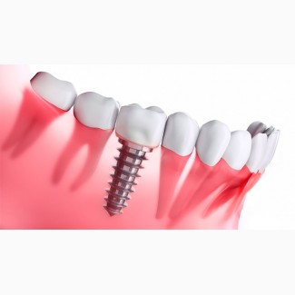 Високоякісна установка зубних імплантів