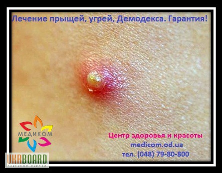 Фото 2. Лечение Демодекса с гарантией! в Одессе