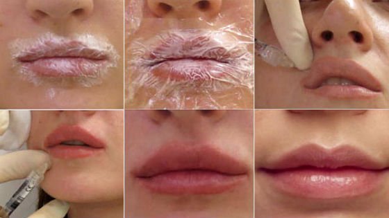 Фото 2. Обучение по контурной пластике губ