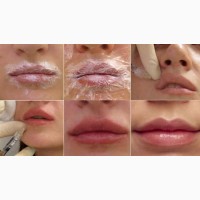 Обучение по контурной пластике губ