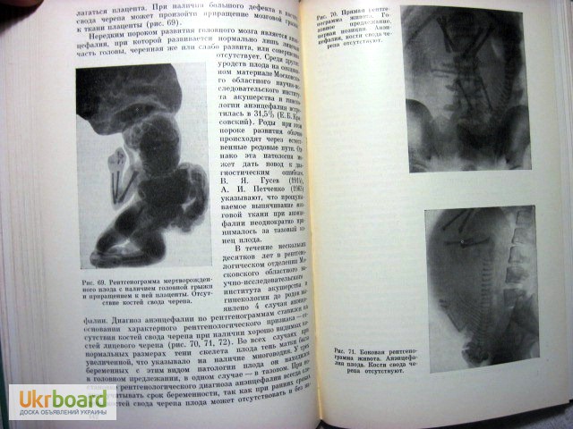 Фото 6. Демидкин Рентгенодиагностика в акушерстве 1969 Руководство для врачей. акушерская патологи