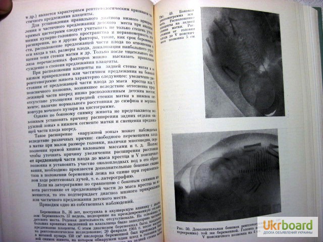 Фото 7. Демидкин Рентгенодиагностика в акушерстве 1969 Руководство для врачей. акушерская патологи