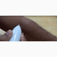 Лазерная ручка Коагулятор Mole Removal для удаления тату, бородавок, пигментных пятен