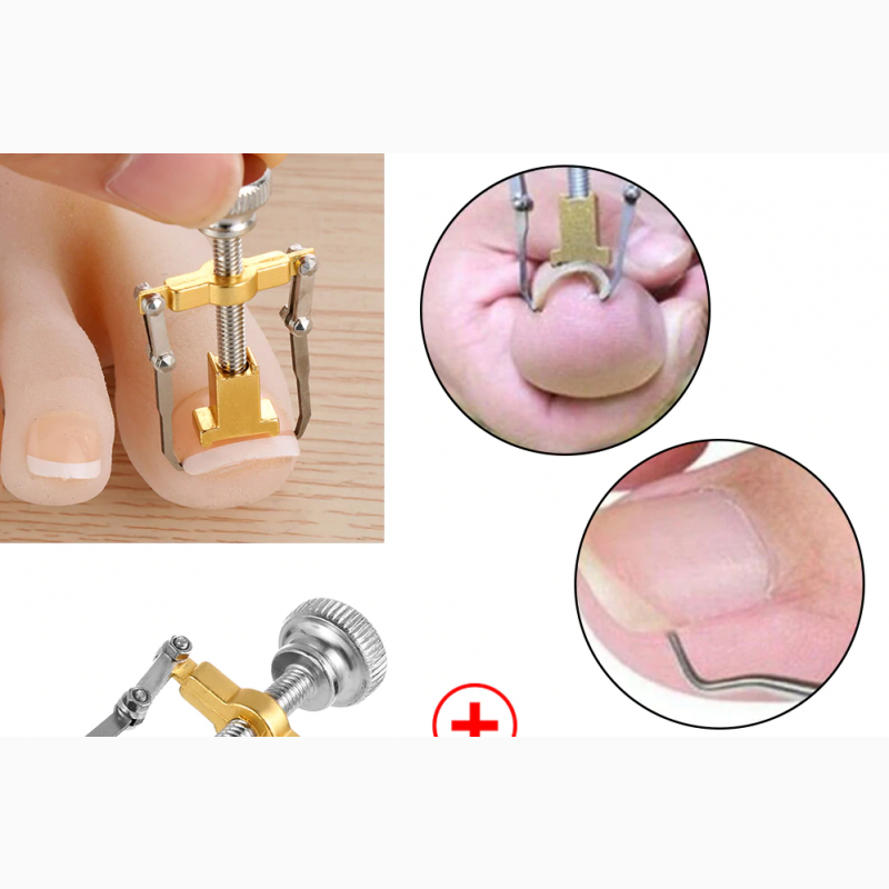 Фото 6. Инструмент Приспособление для лечения и коррекции вросшего ногтя