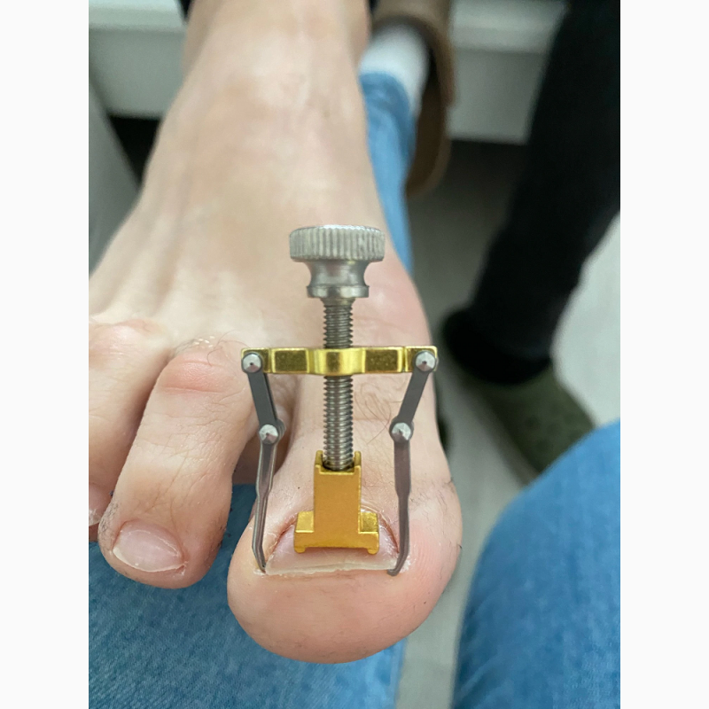 Фото 7. Инструмент Приспособление для лечения и коррекции вросшего ногтя