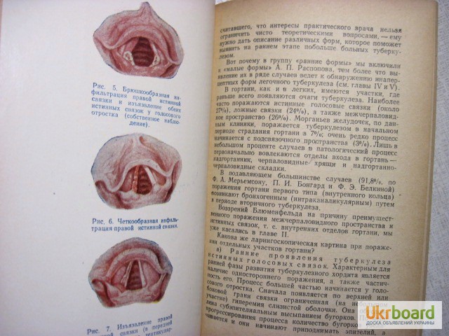 Фото 5. Распознавание ранних форм туберкулеза верхних дыхательных путей 1958 Добромыльский