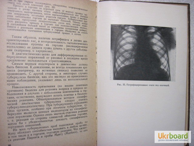 Фото 6. Распознавание ранних форм туберкулеза верхних дыхательных путей 1958 Добромыльский