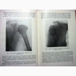 Внутрисуставные переломы Проф Вайнштейн 1959 особенности лечения застарелых травматических