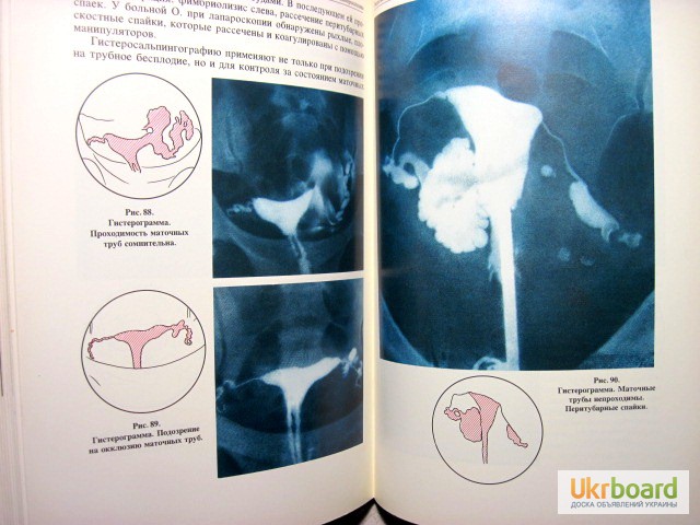 Фото 10. Эндоскопия в гинекологии Савельевой Методика диагностика рекомендации аппаратура лапароско
