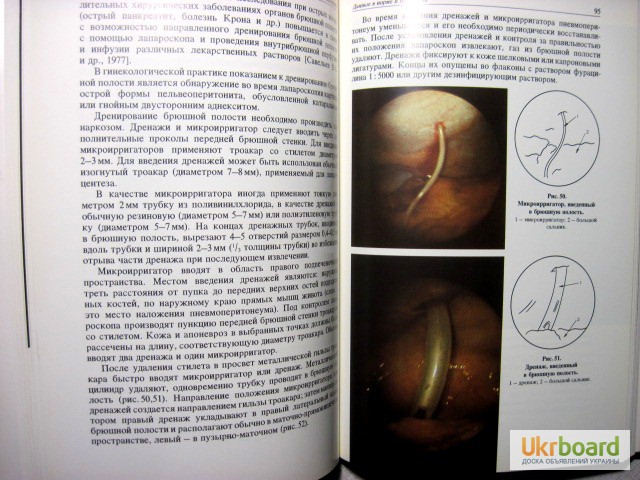 Фото 14. Эндоскопия в гинекологии Савельевой Методика диагностика рекомендации аппаратура лапароско