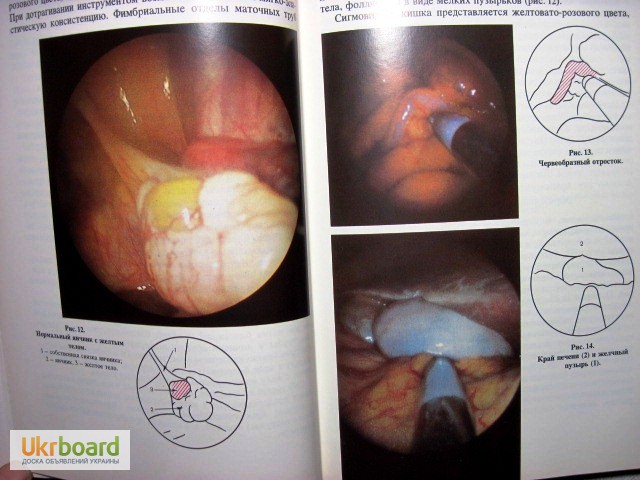Фото 17. Эндоскопия в гинекологии Савельевой Методика диагностика рекомендации аппаратура лапароско