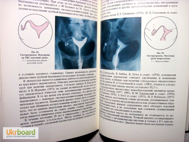 Фото 9. Эндоскопия в гинекологии Савельевой Методика диагностика рекомендации аппаратура лапароско