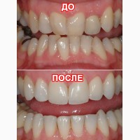 Ортодонт Черкассы - выравнивание зубов